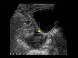 Acute Appendicitis With A Thickened Appendix And An Abscess In Douglas Pouch Appendix Complicated Pouch