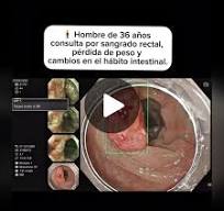 1. 🧍‍♂️ Hombre de 36 años consulta por sangrado rectal, pérdida de peso y  sensación de evacuación incompleta. Durante meses pensó que solo eran  hemorroides. (Siegel RL et al., CA Cancer J Clin. 2023) ...