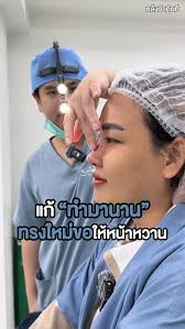 อยากหน้าละมุนขึ้น ใบหน้าสมส่วนขึ้น ตัดปีกจมูกสิคะ🤩 จากปีกจมูกกว้าง บาน  ใบหน้าไม่บาลานซ์ หลังตัดปีกจมุกหน้าเปลี่ยนทันที🥳 👉โปรแกรม #ตัดปีกจมูก กับ  #หมอเชาว์Fernclinic 👃✨ #ปีกจมูกบาน #ตัดปีกจมูกแผลใน #ปีกจมูก #ปีกจมูกกว้าง  #รีวิวตัดปีกจมูก ...