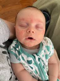 Image result for red rash face