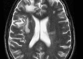Risk For Pml In Multiple Sclerosis Predicted With Anti Jcv