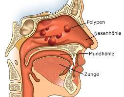 Unter einer entzündung der nase versteht man vor allem zwei erkrankungen, die ganz verschiedene ursachen und symptome haben: Nasenpolypen Polyposis Nasi Apotheken Umschau