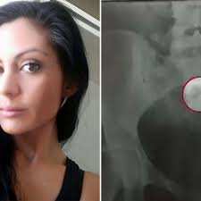 Essure class action: Aussie women still fighting to have controversial  birth control device removed