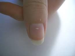 That is about how long it takes the spot to grow past the eponychium (cuticle line). ~doug schoon, author of nail structure and product chemistry according to dr. Leukonychia Wikipedia
