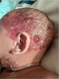 Image result for Urticaria pigmentosa children
