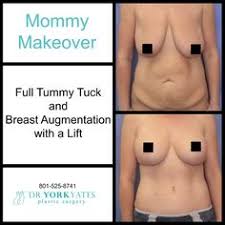 Although the percentage of cases in men is much lower than in women, male breast cancer accounts for a por. 52 Lipo Ideas Tummy Tucks Mommy Makeover Liposuction