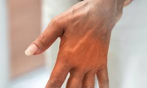 What type of research is being done at the center for peripheral neuropathy? Can Stem Cells Treat Neuropathy Or Nerve Damage National Stem Cell Clinic