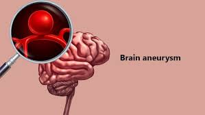 Most aneurysms don't have symptoms until they rupture. Brain Aneurysm Causes Symptoms And Treatments Medlife Blog Health And Wellness Tips