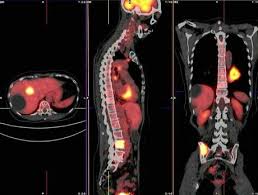 Pet scan whole body cpt code 2020. Pet Ct Scan Whole Body Cpt Code Ct Scan Machine