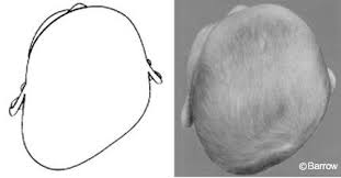 Image result for Positional Head Deformity