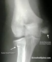 The lateral epicondyle of the humerus is a large, tuberculated eminence, curved a little forward, and giving attachment to the radial collateral ligament of the elbow joint, and to a tendon common to the origin of the supinator and some of the extensor muscles. Xrays Of Elbow Injuries Bone And Spine