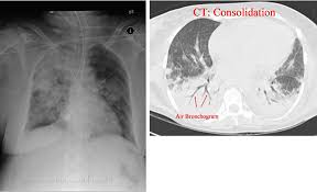 Image result for Air Bronchogram