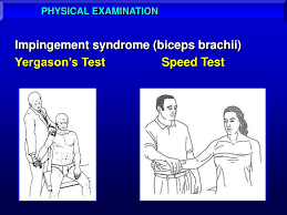 Image result for Yergason Test