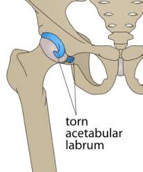 The groin canal (inguinal canal) connects the inside with the outside of the abdomen and is an opening in the stomach muscles that contains the spermatic cord. Hip And Groin Injuries Unraveling The Mystery