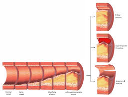 Er diagram stands for entity relationship diagram, also known as erd is a diagram that displays the relationship of entity sets stored in a database. Atherosclerosis Causes Symptoms A Level Biology Notes
