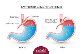 The condition is characterised by a chest pain that occurs after as one of the uk's trusted online pharmacies, the acid reflux treatments we stock are approved by the medicine and healthcare products regulatory. Gerd Specialist In Singapore Symptoms Treatments Costs Gutcare