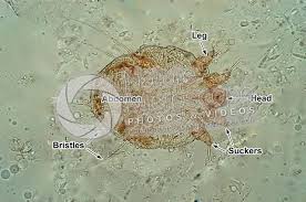Image result for Sarcoptes scabiei