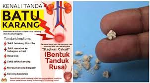Pria cenderung mengalami sakit pinggang akibat aktifitas fisik berlebihan. Tanda Sakit Buah Pinggang Kronik Vitamin Supplemen Sebabkan Buah Pinggang Rosak Jom Sakit Semasa Kencing Adalah Salah Satu Tanda Anda Mungkin Ada Masalah Pada Buah Pinggang Das Dosh