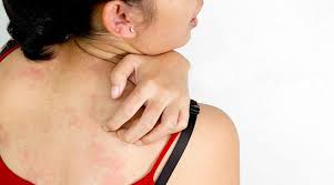 From being in a dirty pool. Hives 101 What Causes Hives And How To Get Rid Of Them Fast Era Organics