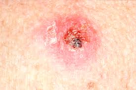 If you are concerned about a lump under your skin, don&#x27;t hesitate to get it checked out — especially since cancer cannot be diagnosed without a doctor. File Crusty Skin Lump Jpg Wikimedia Commons