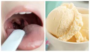 Biasanya untuk mengatasi gatal pada kulit, orang lebih memilih. Betul Ke Makan Aiskrim Vanilla Boleh Sembuhkan Sakit Tonsil Ini Jawapan Doktor