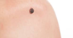 Warts Removal New York NY - Signs, Symptoms & Treatment | Dr. Comite