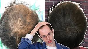 Smp scalp hair tattoo is now being recognized as the new, permanent solution to hair loss or thinning hair for men and women. Microblading My Scalp For Balding Youtube