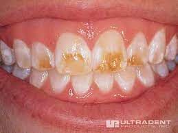 Spark aligners are more clear, more comfortable, stain less and designed for more efficient and effective tooth movement, compared to the leading aligner brand.* Brown Stains On Teeth After Braces Removed Teethwalls