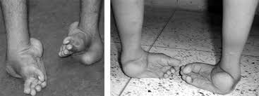 If it comes back, some of the treatment stages may need to be repeated. Clubfoot Orthoinfo Aaos
