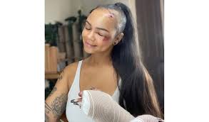 Candice huffine is notable for landing vogue italia's cover in 2011 as well as being a great editorial model. Ig Model Badly Beaten For Being Too Pretty Ripped Out Her Baby Hairs Pics News Nation Usa