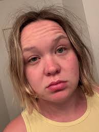 Gluten exposure symptoms and recovery experiences