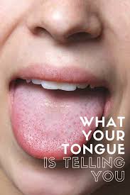 What You Tongue Can Tell You About Your Health Dental Advertising Told You So Dental Laser