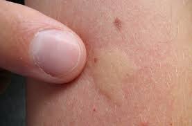 Enfin, en cas de piqûre liée à une allergie dangereuse, il est important de contacter les secours qui pourront administrer un antivenimeux. Prevenir Les Piqures D Insectes Planete Sante