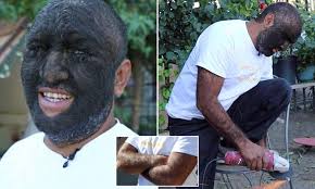 Know Larry Gomes, a person with hair skin at 98 % Larry Gomes famous as  'Wolf man', is a human being who over 98 % of his whole body covered with  hair (