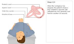 Image result for Canalith Repositioning Procedure
