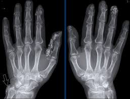 Image result for XRay Changes in Rheumatic Conditions
