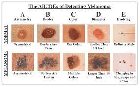 People with fair skin run the greatest risk. Skin Cancer Thousand Oaks Pierre Skin Care Institute