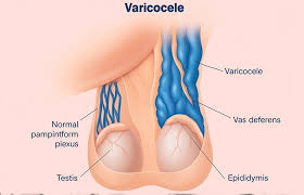 Image result for Varicocele
