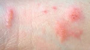 Allergic Reactions And Rashes Causes Diagnosis And Treatment