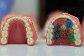 • most people have already turned the heat on. Retainer Care Timonium Md Orthodontics Lutherville
