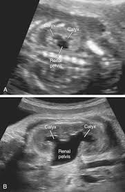 .joints and articular cartilage of limbs c41 bones, joints and articular cartilage of other and unspecified sites c65 renal pelvis c66 ureter c67 bladder c68 other and unspecified urinary organs. Renal Pelvis Dilatation Sciencedirect