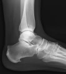 The superomedial surface of the talus bone articulates with the medial malleolus of the tibia, the top of the talus. Plantar Fasciosis Musculoskeletal And Connective Tissue Disorders Msd Manual Professional Edition