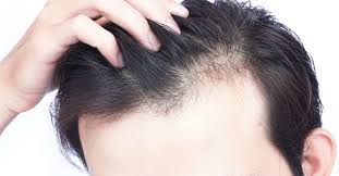 You have a zinc deficiency. Vitamin D Deficiency Hair Loss Symptoms And Treatment