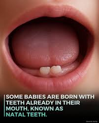 Image result for Neonatal Teeth