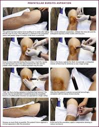 Image result for Prepatellar Bursa Injection