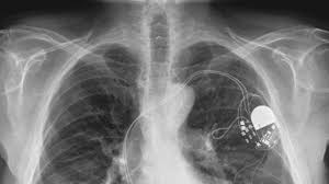 This topic review will discuss pa. Pacemakers And Hacker Dangers
