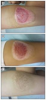 Healing typically does not occur on its own. Treatment Of Minor Thermal Burns Uptodate