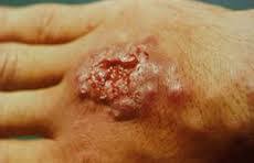 Maybe you would like to learn more about one of these? Sporotrichosis Singapore Pdf Ppt Case Reports Symptoms Treatment