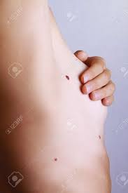 This can cause more pain and take longer to clear up than a normal pimple because it can't easily travel to the surface. Young Woman Holding Her Arms Up And Showing Underarms Armpit Birthmark On Skin Checking Benign Moles Stock Photo Picture And Royalty Free Image Image 45163676