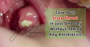 Strep Throat Is Caused By The Streptococcus Pyogenes Bacteria And Is More Common In Children Strep Throat Strep Throat Remedies Natural Strep Throat Remedies